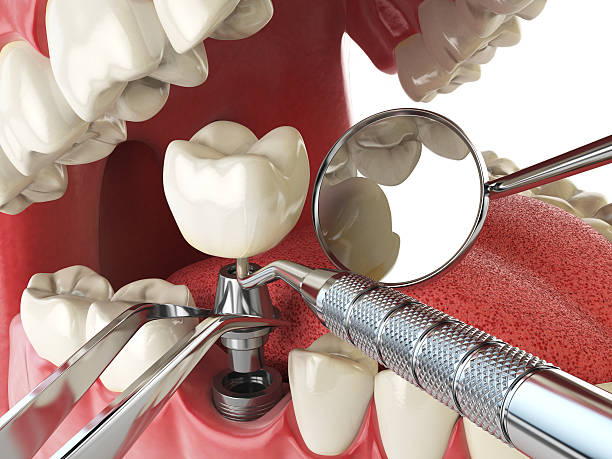 Best Emergency Broken Tooth Repair in Weatherford, TX